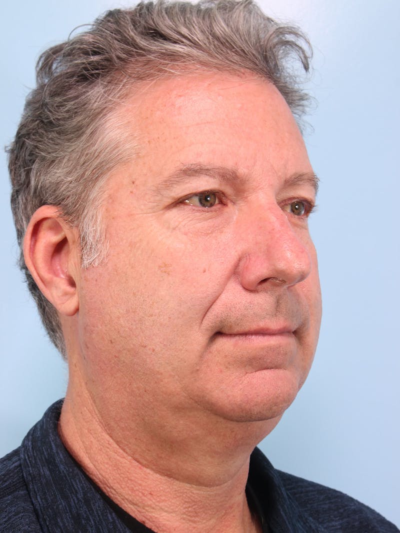 Lower Blepharoplasty Before & After Gallery - Patient 189988 - Image 3