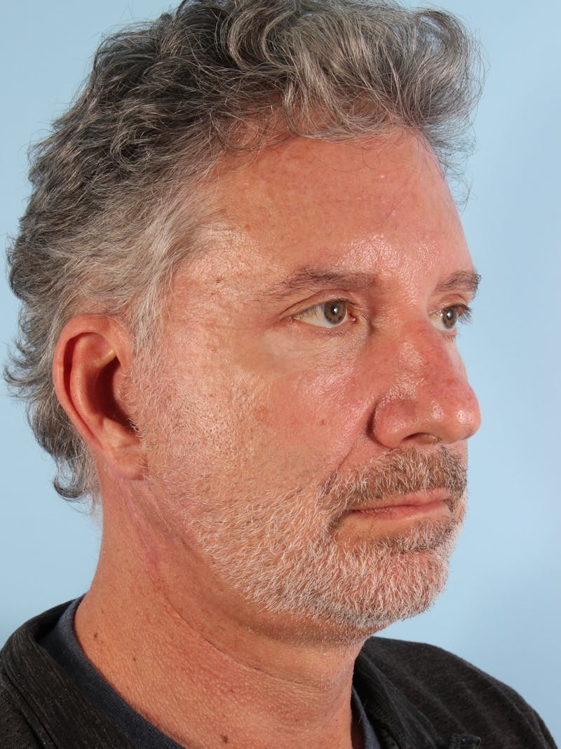 Lower Blepharoplasty Before & After Gallery - Patient 189988 - Image 4