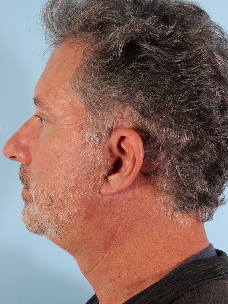 Lower Blepharoplasty Before & After Gallery - Patient 189988 - Image 6