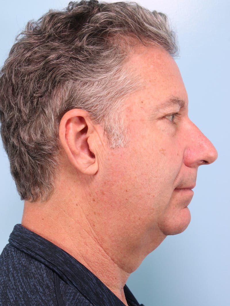 Lower Blepharoplasty Before & After Gallery - Patient 189988 - Image 7