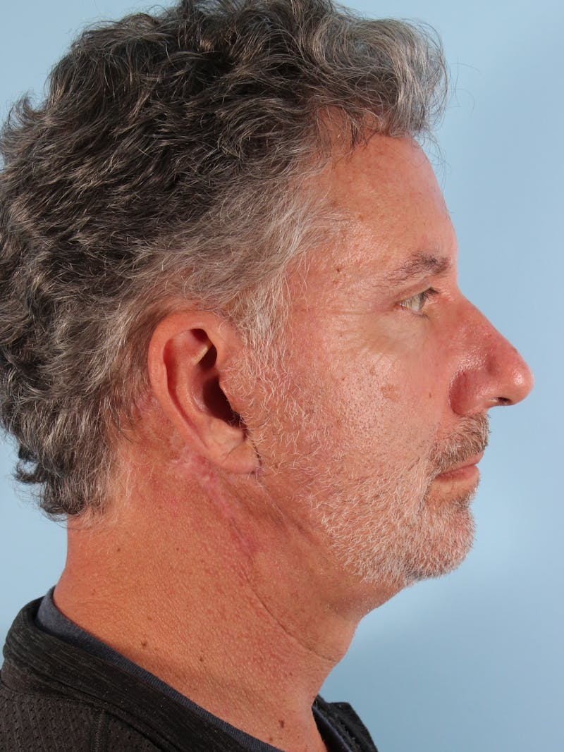 Lower Blepharoplasty Before & After Gallery - Patient 189988 - Image 8