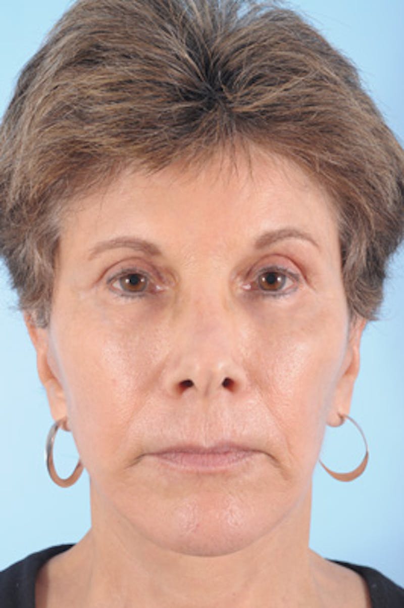 Lower Blepharoplasty Before & After Gallery - Patient 389215 - Image 2