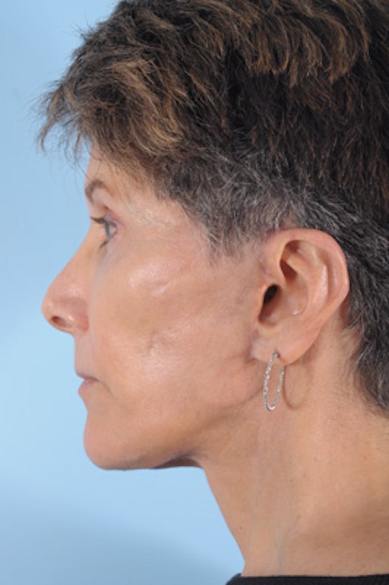 Lower Blepharoplasty Before & After Gallery - Patient 389215 - Image 4