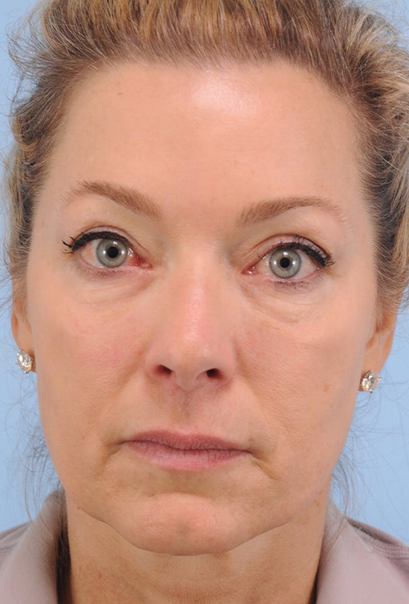 Lower Blepharoplasty Before & After Gallery - Patient 332528 - Image 1