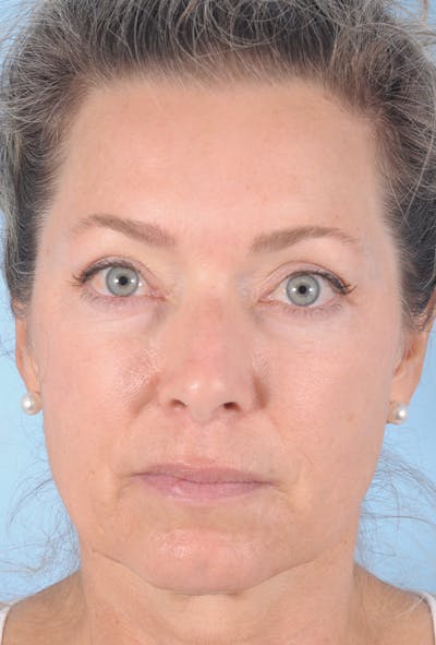 Lower Blepharoplasty Before & After Gallery - Patient 332528 - Image 2