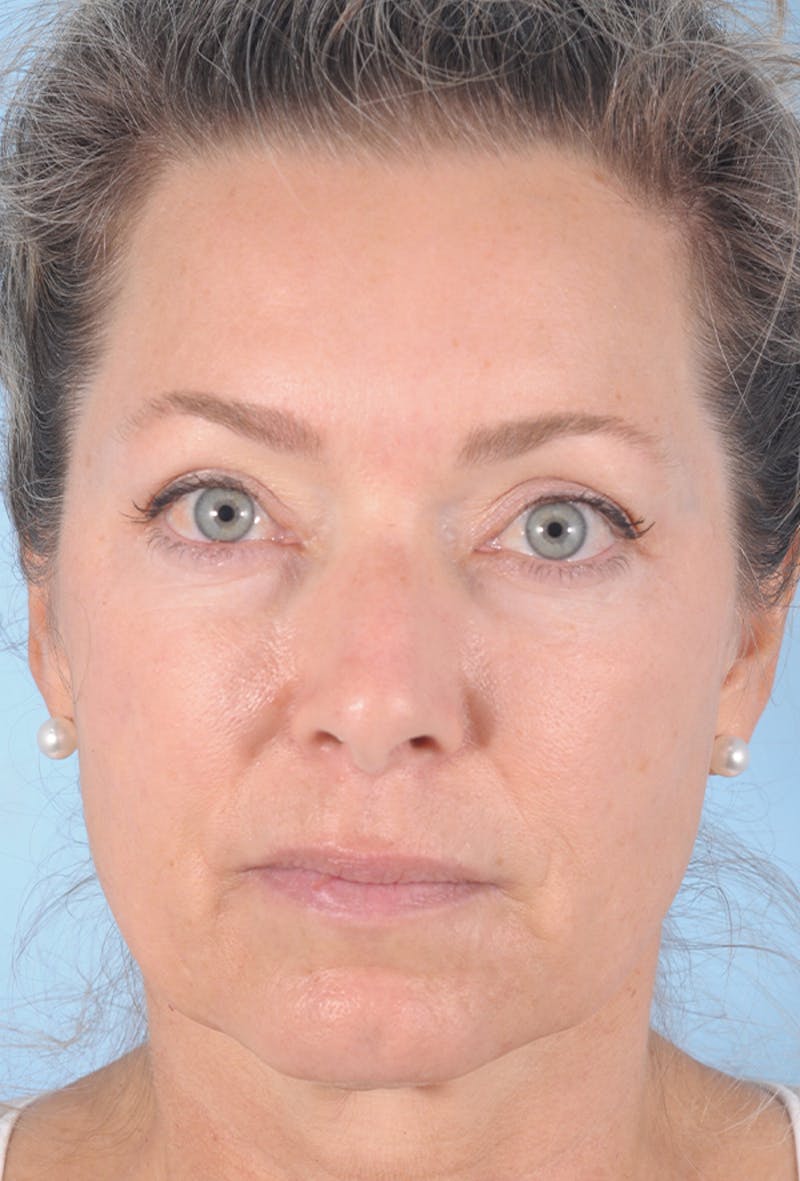 Lower Blepharoplasty Before & After Gallery - Patient 332528 - Image 2