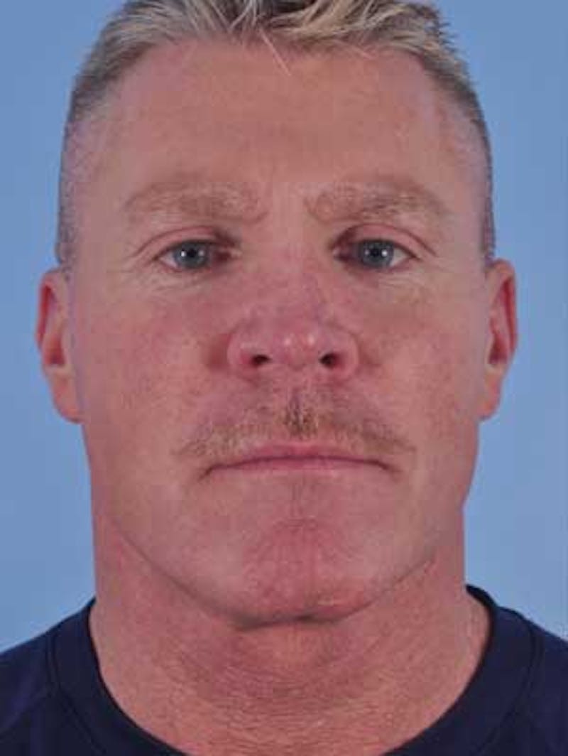 Cheek Implants Before & After Gallery - Patient 204632 - Image 1