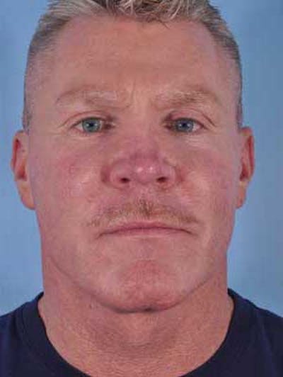 Cheek Implants Before & After Gallery - Patient 204632 - Image 2