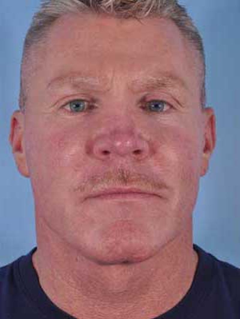 Cheek Implants Before & After Gallery - Patient 204632 - Image 2