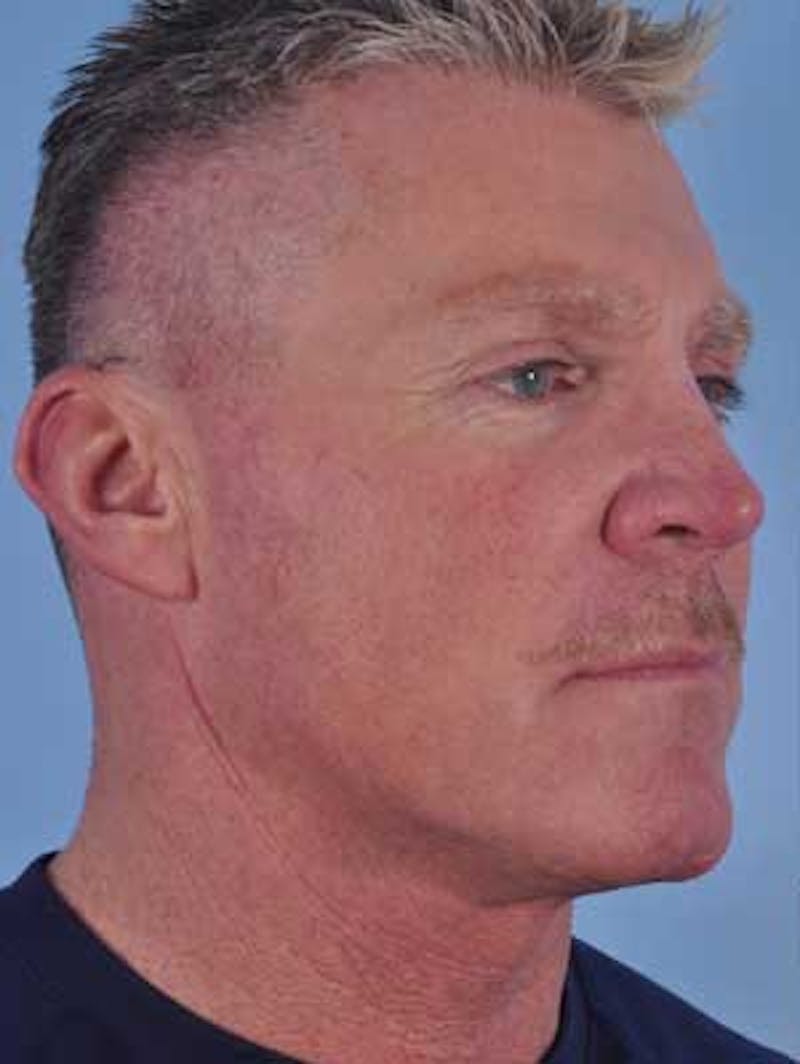 Cheek Implants Before & After Gallery - Patient 204632 - Image 3