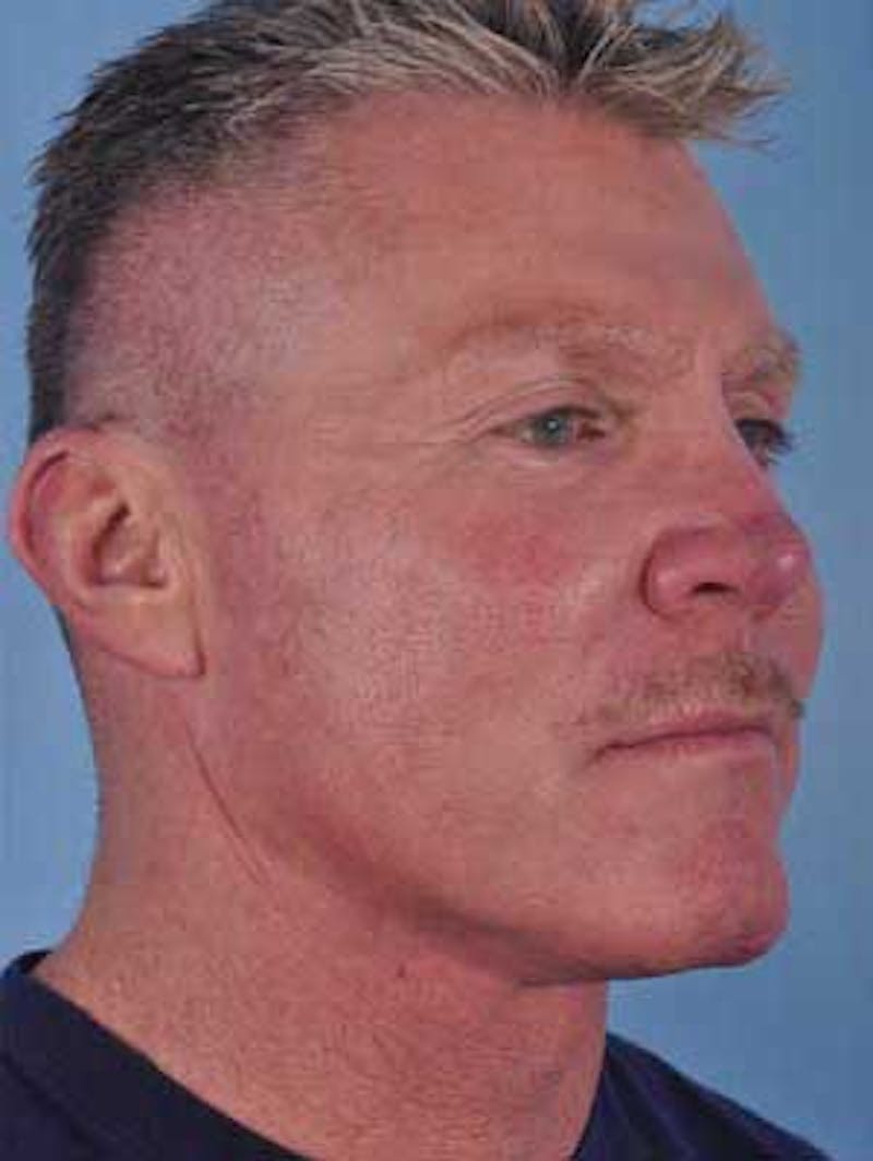 Cheek Implants Before & After Gallery - Patient 204632 - Image 4