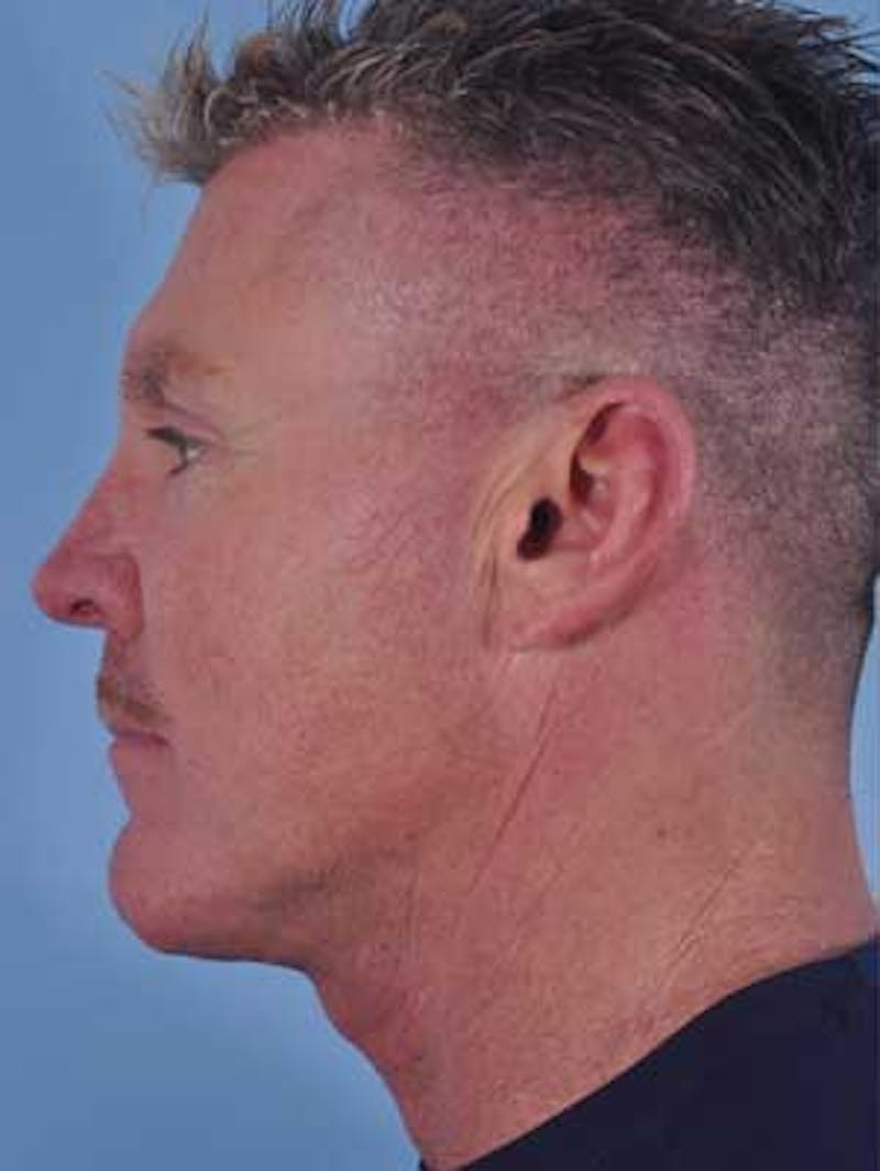 Cheek Implants Before & After Gallery - Patient 204632 - Image 5