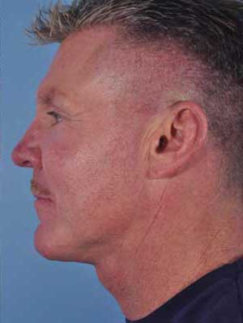 Cheek Implants Before & After Gallery - Patient 204632 - Image 6