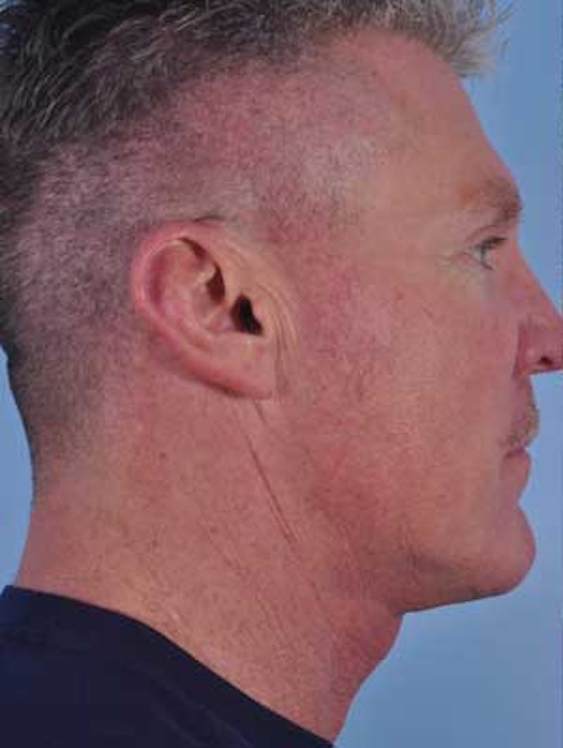 Cheek Implants Before & After Gallery - Patient 204632 - Image 7