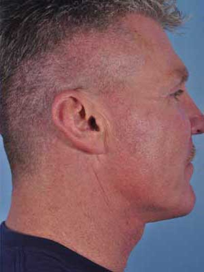Cheek Implants Before & After Gallery - Patient 204632 - Image 8