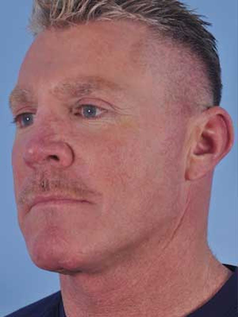 Cheek Implants Before & After Gallery - Patient 204632 - Image 9