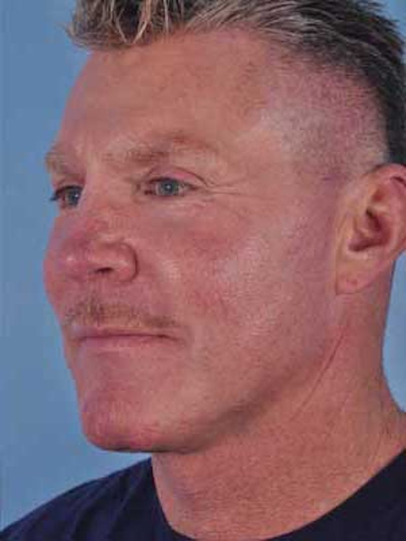 Cheek Implants Before & After Gallery - Patient 204632 - Image 10