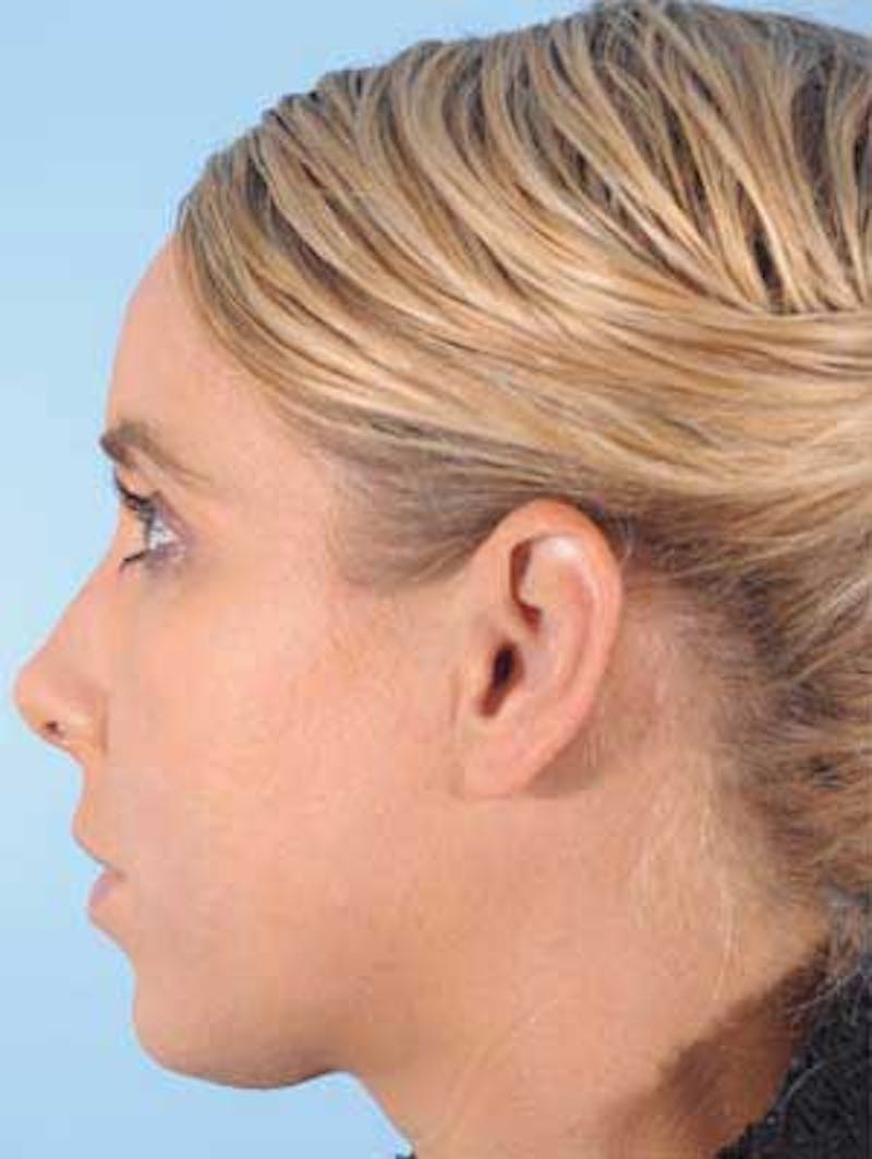Cheek Implants Before & After Gallery - Patient 380993 - Image 3