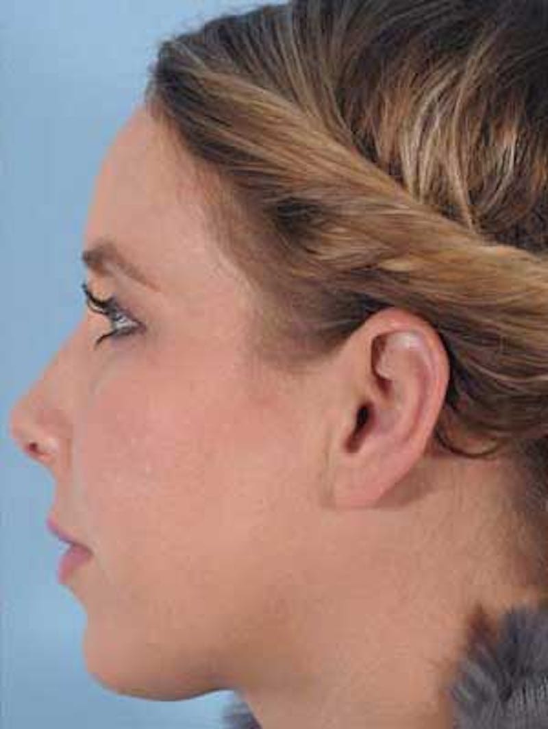 Cheek Implants Before & After Gallery - Patient 380993 - Image 4