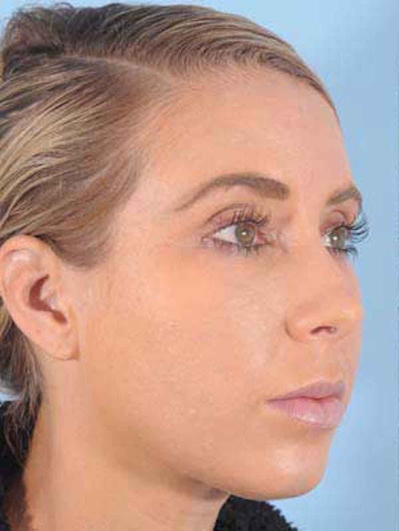 Cheek Implants Before & After Gallery - Patient 380993 - Image 5