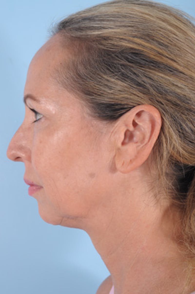 Chin Implant Before & After Gallery - Patient 293732 - Image 1