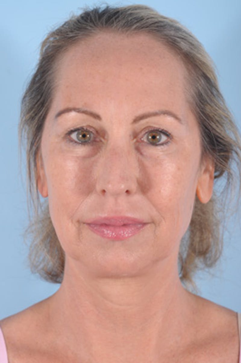 Chin Implant Before & After Gallery - Patient 293732 - Image 3