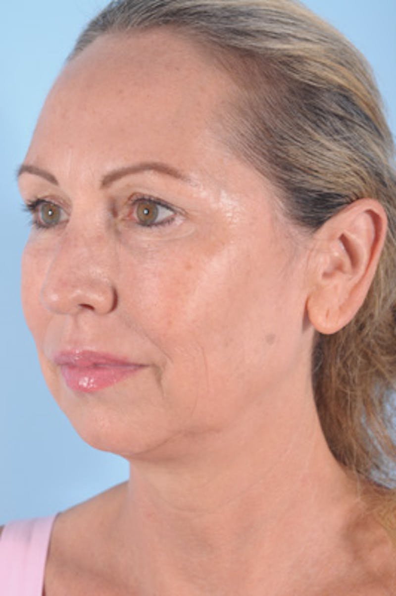Chin Implant Before & After Gallery - Patient 293732 - Image 5
