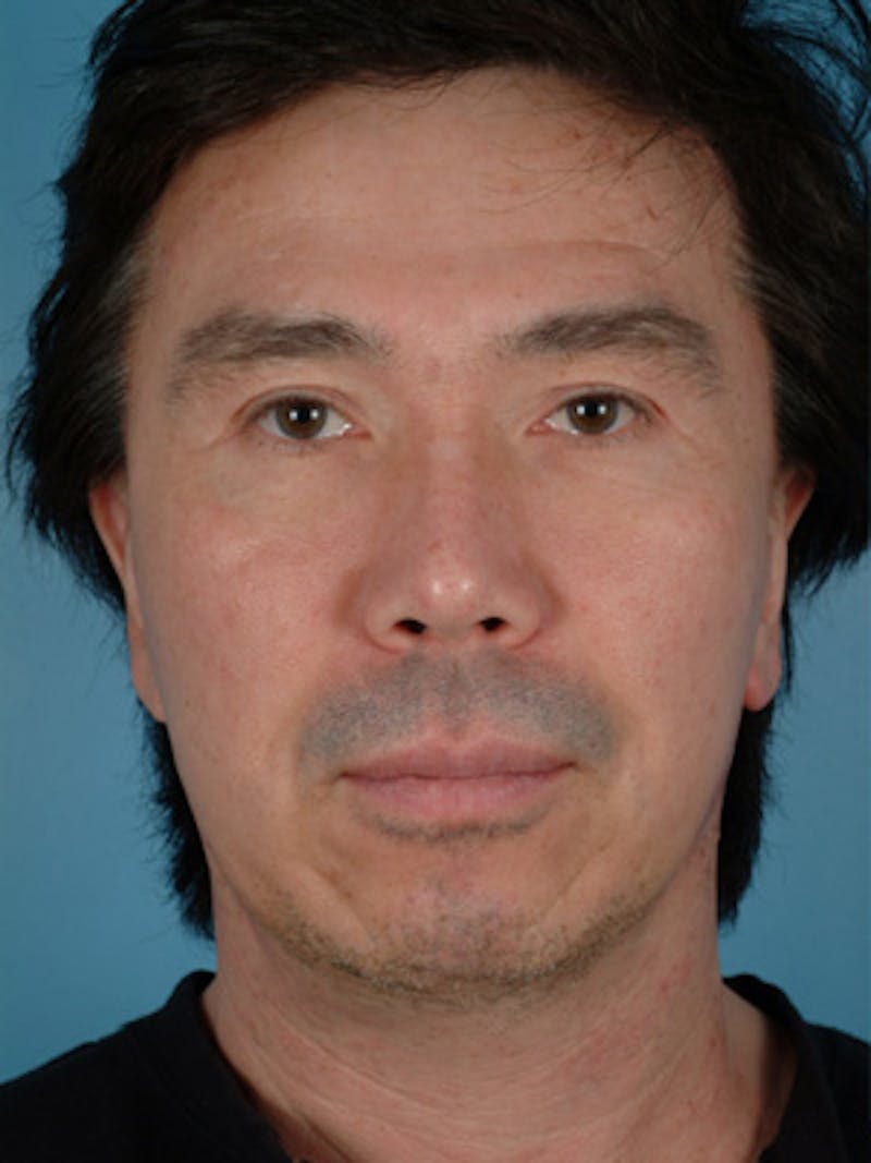 Chin Implant Before & After Gallery - Patient 378461 - Image 3