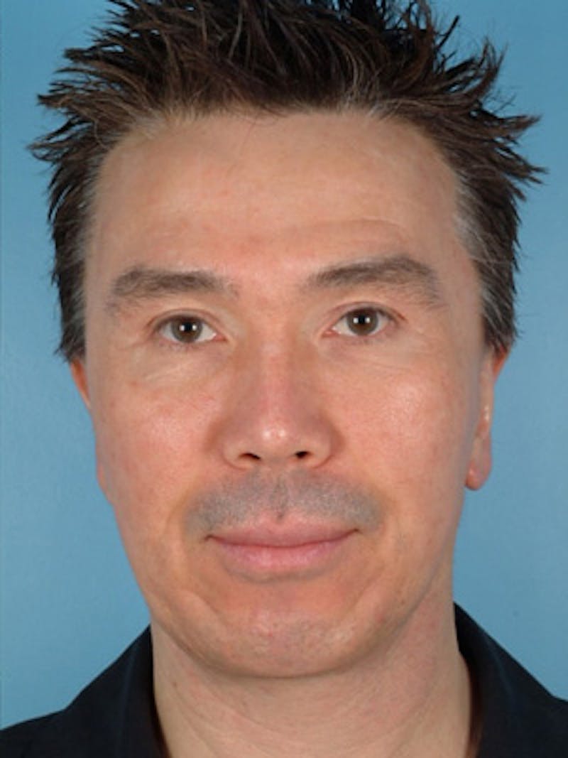 Chin Implant Before & After Gallery - Patient 378461 - Image 4