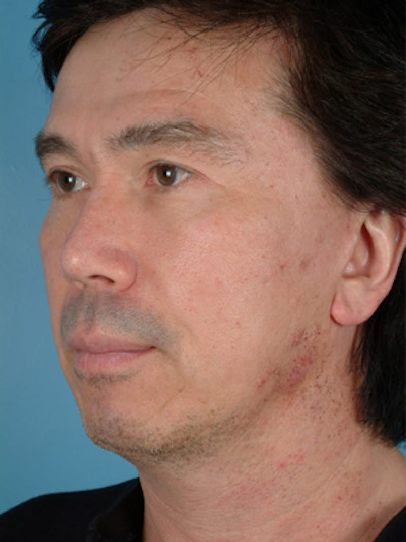 Chin Implant Before & After Gallery - Patient 378461 - Image 5