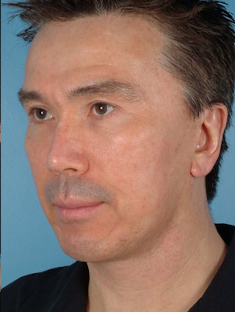 Chin Implant Before & After Gallery - Patient 378461 - Image 6