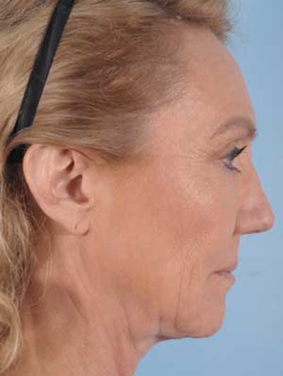 Chin Implant Before & After Gallery - Patient 390005 - Image 1