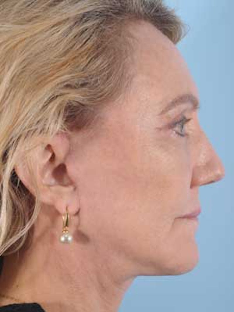 Chin Implant Before & After Gallery - Patient 390005 - Image 2