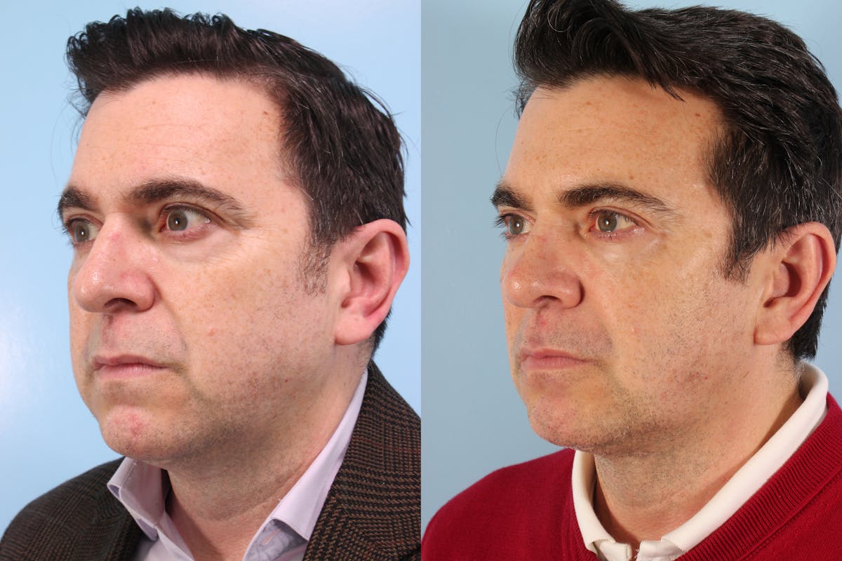 Liposuction Submental Before & After Gallery - Patient 422406 - Image 1