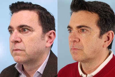 Liposuction Submental Before & After Gallery - Patient 422406 - Image 1