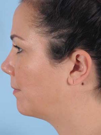 Earlobe Repair Before & After Gallery - Patient 105820 - Image 1