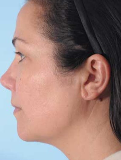 Earlobe Repair Before & After Gallery - Patient 105820 - Image 2