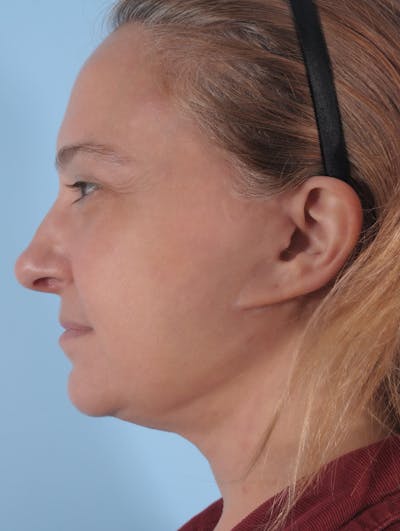 Earlobe Repair Before & After Gallery - Patient 398517 - Image 1