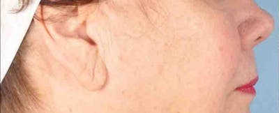 Earlobe Repair Before & After Gallery - Patient 256476 - Image 1