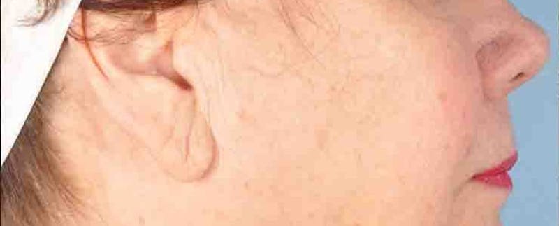 Earlobe Repair Before & After Gallery - Patient 256476 - Image 1