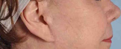 Earlobe Repair Before & After Gallery - Patient 256476 - Image 2