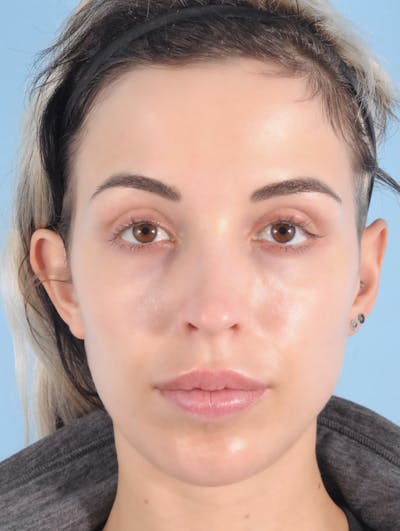 Forehead Reduction / Hairline Lowering Before & After Gallery - Patient 472782 - Image 1