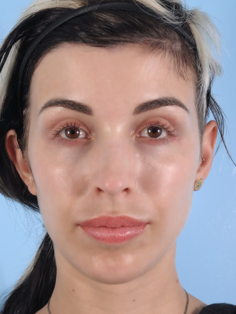 Forehead Reduction / Hairline Lowering Before & After Gallery - Patient 472782 - Image 2