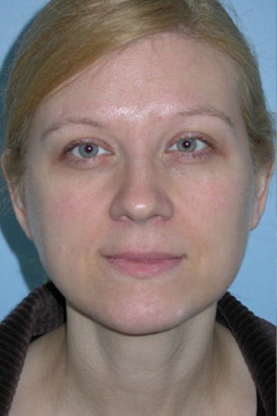 Lip Lift / Implants Before & After Gallery - Patient 396962 - Image 1