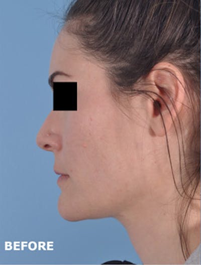 Lip Lift / Implants Before & After Gallery - Patient 199360 - Image 1