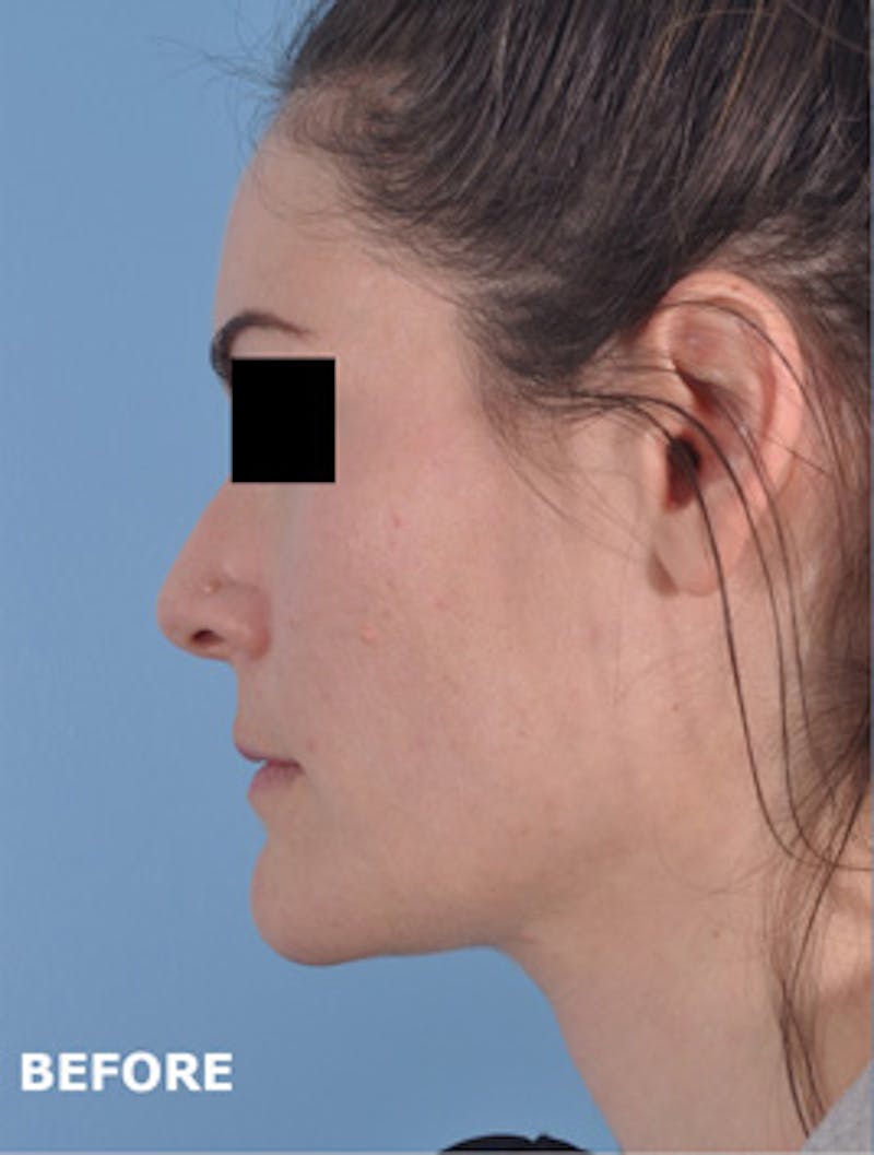 Lip Lift / Implants Before & After Gallery - Patient 199360 - Image 1