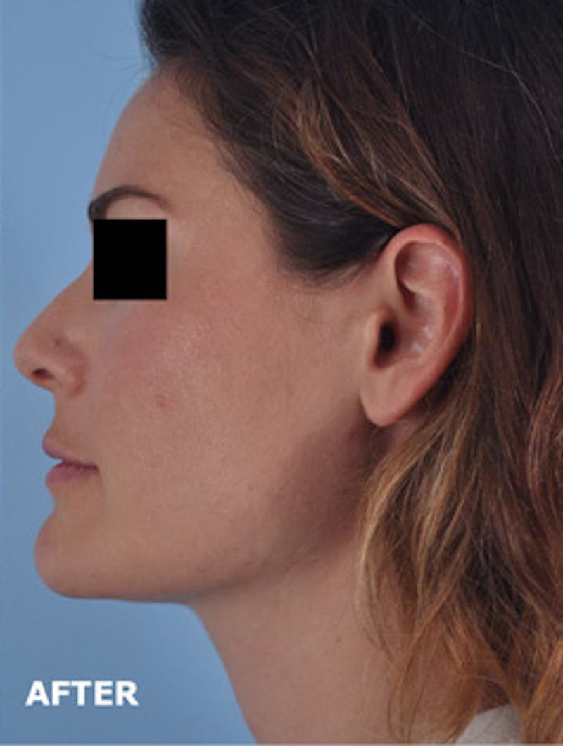 Lip Lift / Implants Before & After Gallery - Patient 199360 - Image 2