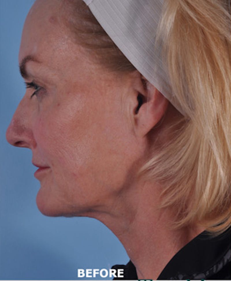 Facial Resurfacing Before & After Gallery - Patient 219397 - Image 1
