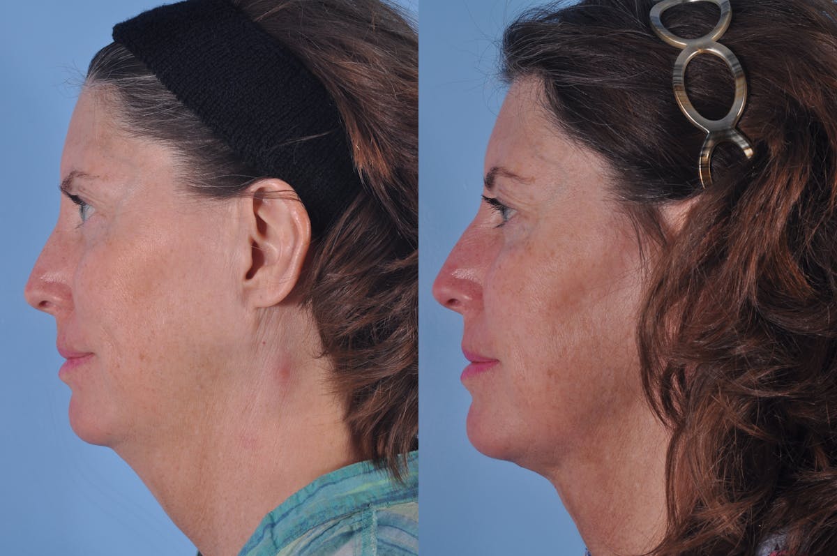 Liposuction Submental Before & After Gallery - Patient 423404 - Image 1