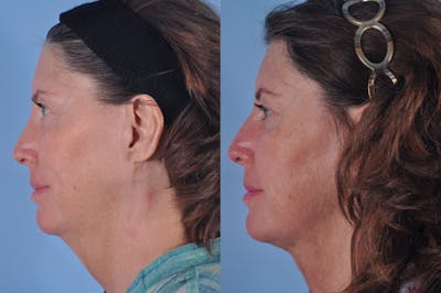 Liposuction Submental Before & After Gallery - Patient 423404 - Image 1